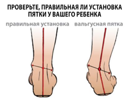 Valgus deformitás a láb - típusai, tünetei, kezelések