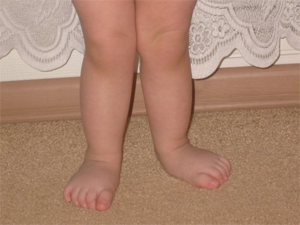 Valgus deformitás a láb - típusai, tünetei, kezelések