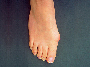 Valgus deformitás a láb - típusai, tünetei, kezelések