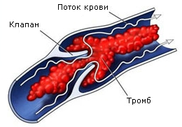 Варикозне розширення вен в питаннях і відповідях