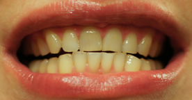 Ați decis să vă albiți dinții, articolele despre albire