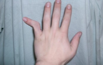 Вивих фаланги пальця руки причини, симптоми, діагностика, лікування, реабілітація