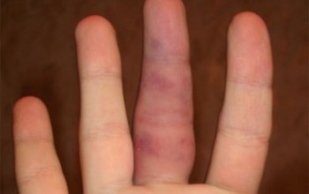 Вивих фаланги пальця руки причини, симптоми, діагностика, лікування, реабілітація