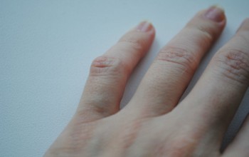 Dislocarea cauzelor falangelor cu deget, simptome, diagnostic, tratament, reabilitare
