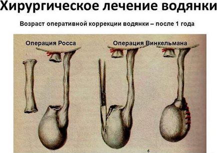 Воднянка на тестисите при мъжките бебета какво е, причини, симптоми и лечение на хидроцеле