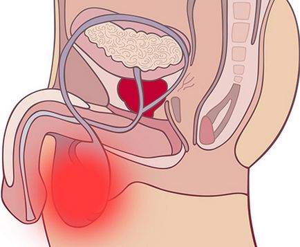 Dropsy of testicles la băieții nou-născuți ceea ce este, cauze, simptome și tratamentul hidrocelei