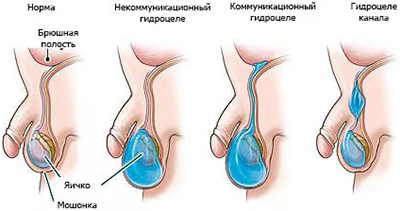 Dropsy of testicles la băieții nou-născuți ceea ce este, cauze, simptome și tratamentul hidrocelei