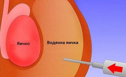 Dropsy of testicles la băieții nou-născuți ceea ce este, cauze, simptome și tratamentul hidrocelei