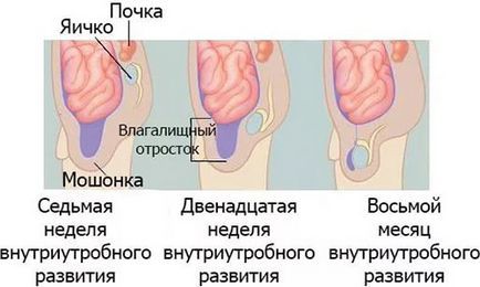 Водянка яєчок у новонароджених хлопчиків що це таке, причини, симптоми і лікування гідроцеле