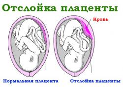 Întrebarea este dacă spikele din organele pelvine sunt detectate în timpul sarcinii, pot