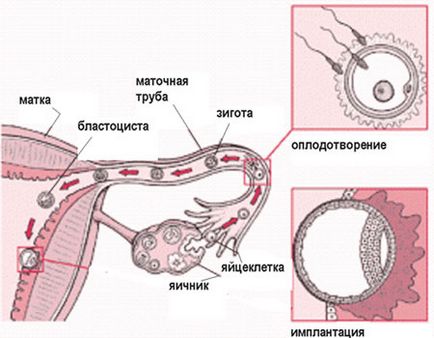 Restaurarea permeabilității trompelor uterine