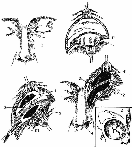 Deschiderea sinusului frontal, operații pe față și în cavitatea bucală