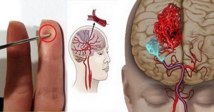 Abban az esetben, a stroke, az életed megmenti tű rastimul élet workshop