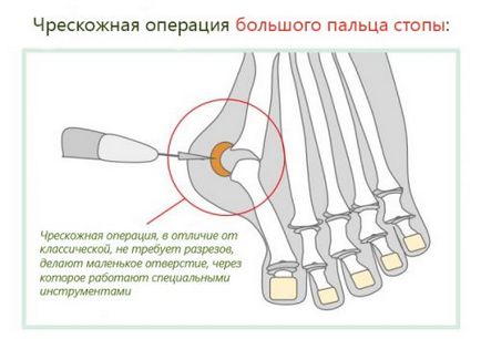 Halus valgus tipuri de funcționare și caracteristicile procedurii