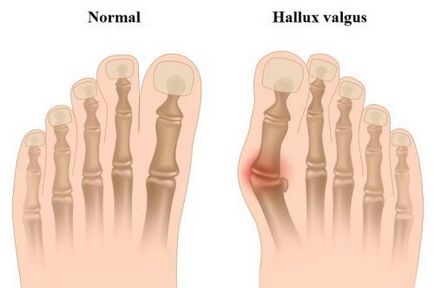 Halus valgus tipuri de funcționare și caracteristicile procedurii