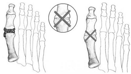 Halus valgus tipuri de funcționare și caracteristicile procedurii