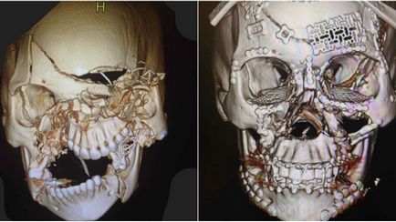 Chirurgul în bucăți a strâns craniul pacientului, ina
