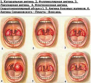 Chlorophillipt angina zsíros és alkohol oldatok