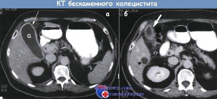 Холецистит (запалення жовчного міхура)