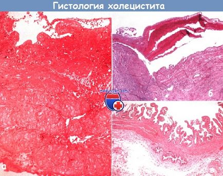 Холецистит (запалення жовчного міхура)