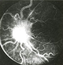 Densitatea nervului optic congestiv (DSN) - cauze, simptome și tratament