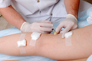 7 Metode de tratament a venelor varicoase