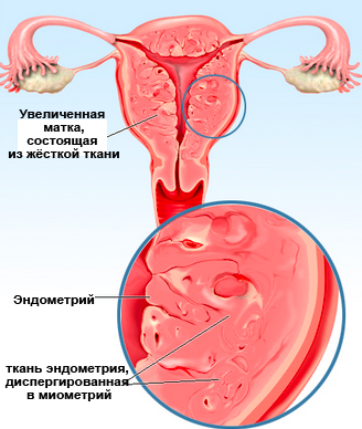 Adenomioza și sarcina ca fiind gravidă cu acest diagnostic