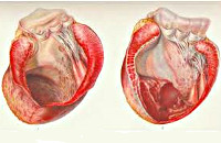 Аневризма серця - причини, симптоми, діагностика та лікування