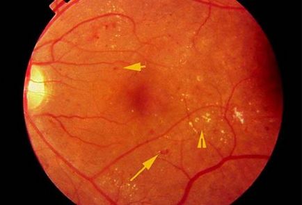 Angiopatia retinei ochilor provoacă, simptome și terapii