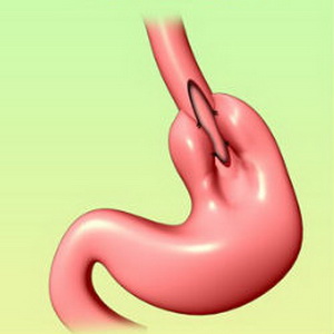 Achalasia esofagului - simptome, cauze, tratament și diagnostic