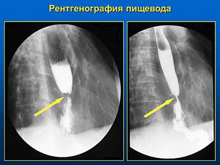 Achalasia esofagului - simptome, cauze, tratament și diagnostic