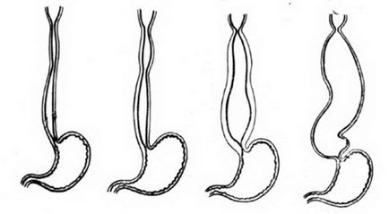 Achalasia esofagului - simptome, cauze, tratament și diagnostic