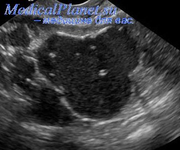 Biopsia tumorilor pancreatice