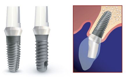 Biotech fogászati ​​implantátum rendszer - a biotechnológiai implantátumok Krasznojarszk - Krasznojarszk Alwi -