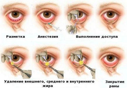 Blefaroplastia pleoapei inferioare, indicații și contraindicații, complicații, reabilitare, recenzii, fotografii,