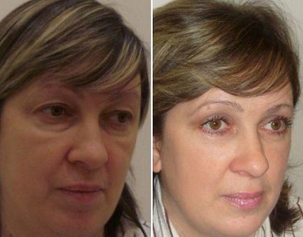 Blefaroplastia pleoapei inferioare, indicații și contraindicații, complicații, reabilitare, recenzii, fotografii,