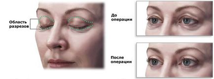 Blepharoplasty felső szemhéj