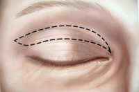 Blepharoplasty felső szemhéj