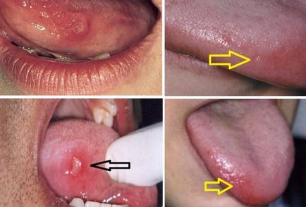 Болячка на мові утворення білого кольору, як лікувати