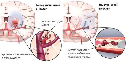 Care sunt cauzele accident vascular cerebral de simptome, factori de risc, relief, prevenire