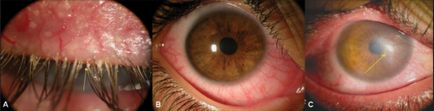Demodectic simptome ochi și tratament