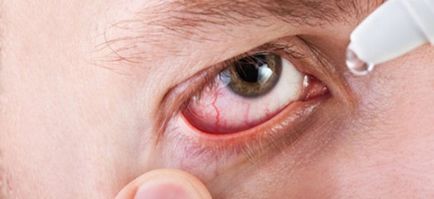 Демодекоз очей симптоми і лікування