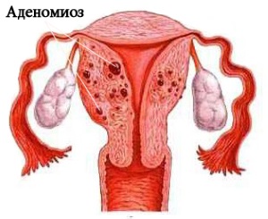 Diagnosticul și tratamentul adenomiozelor înainte și după naștere