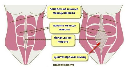 Діастаз прямих м'язів живота після пологів що це таке, як визначити, ознаки розбіжності м'язової