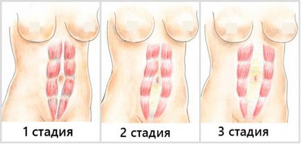 Diastaza musculaturii abdominale rectus după naștere este ceea ce este să determini semnele unei divergențe a musculaturii