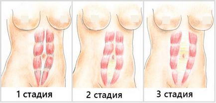 Діастаз прямих м'язів живота після пологів що це таке, як визначити, ознаки розбіжності м'язової