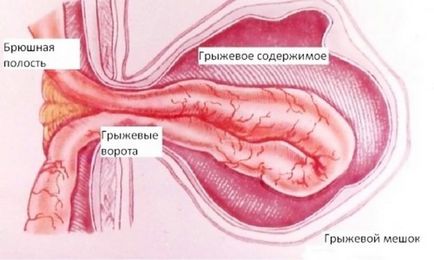 Diastaza musculaturii abdominale rectus după naștere este ceea ce este să determini semnele unei divergențe a musculaturii