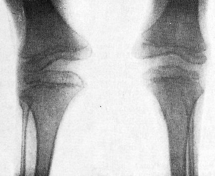 Displazie disprofică (disostoză epifizală), jurnal de articole medicale 