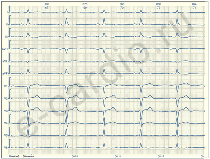 E-cardio semne de ischemie