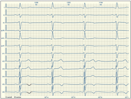 E-cardio semne de ischemie